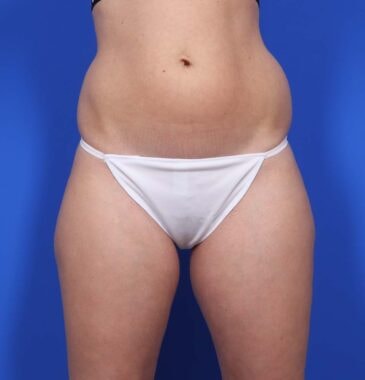 Case # 25 before photo