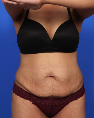 Case # 122 before photo