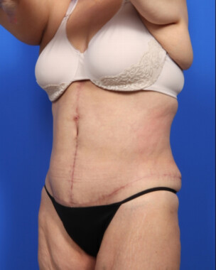 Case # 9 after photo