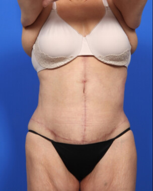 Case # 9 after photo