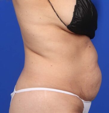 Case # 1 before photo