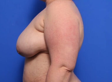 Case # 16 after photo