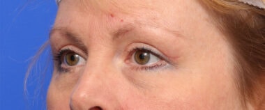 Case # 13 after photo