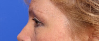 Case # 13 after photo