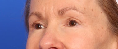 Case # 14 after photo