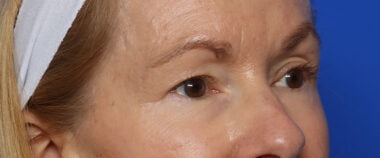 Case # 14 before photo