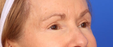 Case # 14 after photo