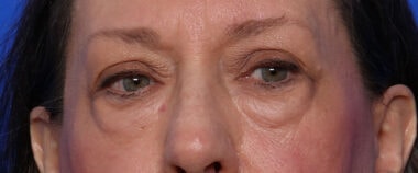 Case # 15 before photo