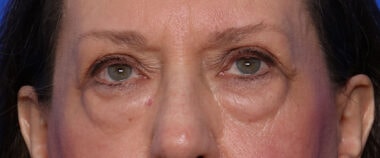 Case # 15 before photo