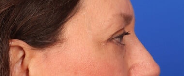 Case # 15 after photo