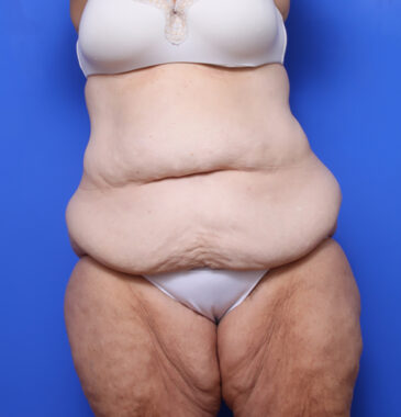 Case # 1 before photo