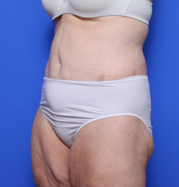 Case # 1 after photo