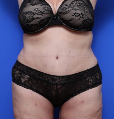 Case # 2 after photo