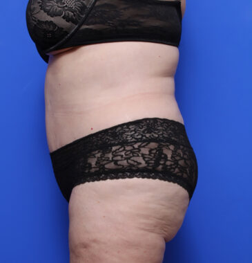 Case # 2 after photo