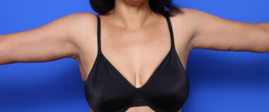 Case # 2 after photo