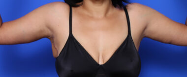 Case # 2 after photo