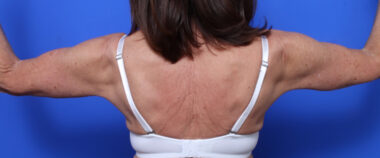 Case # 4 after photo