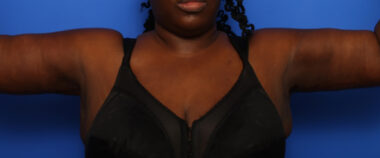 Case # 5 after photo