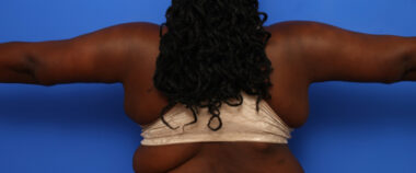 Case # 5 after photo