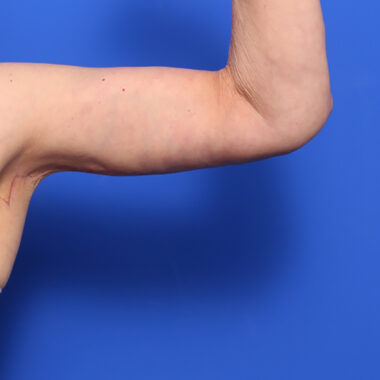 Case # 6 after photo