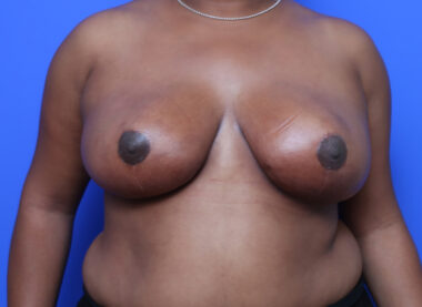 Case # 18 after photo