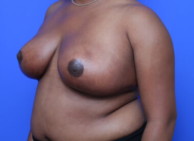 Case # 18 after photo