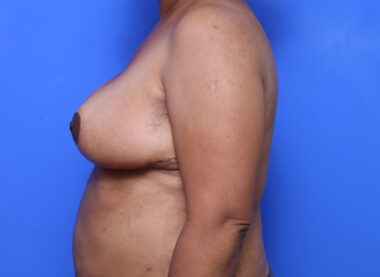 Case # 25 after photo