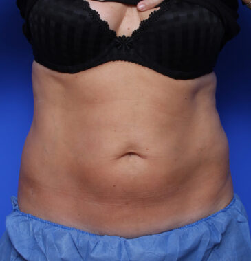 Case # 4 after photo