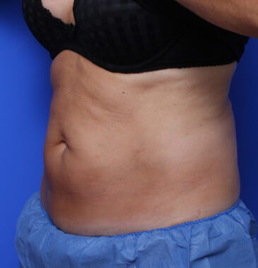 Case # 4 after photo