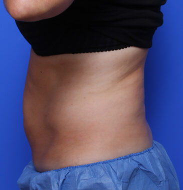 Case # 4 after photo