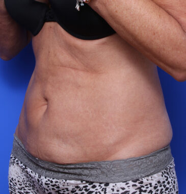 Case # 9 after photo