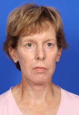 Case # 10 after photo