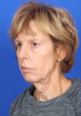 Case # 10 before photo