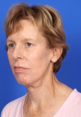 Case # 10 after photo