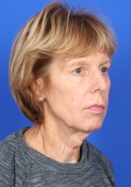 Case # 10 before photo