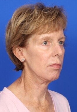 Case # 10 after photo