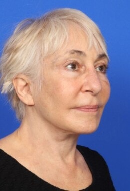 Case # 7 after photo