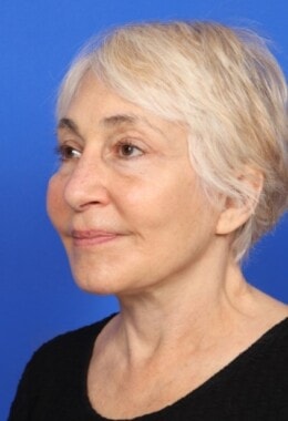 Case # 7 after photo