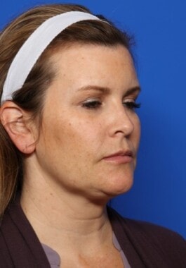 Case # 2 before photo