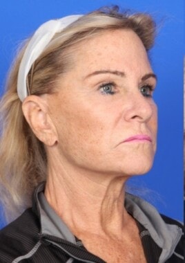 Case # 8 before photo