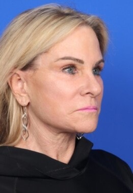 Case # 8 after photo