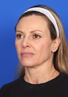 Case # 3 before photo