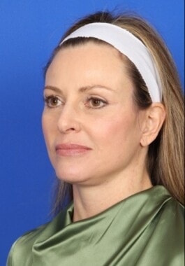 Case # 3 after photo