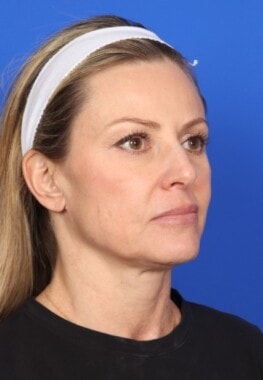 Case # 3 before photo