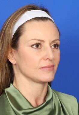 Case # 3 after photo