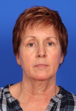 Case # 17 before photo