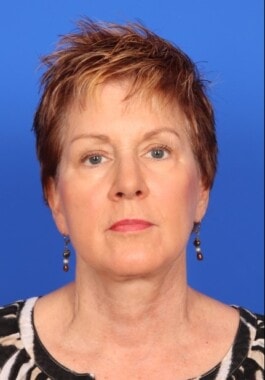 Case # 17 after photo