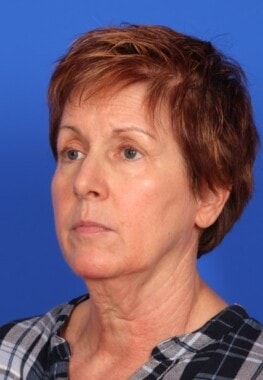 Case # 17 before photo