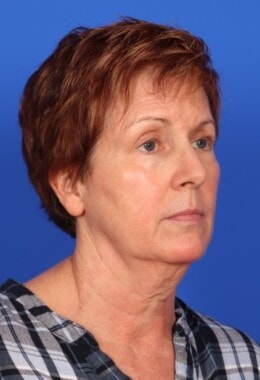 Case # 17 before photo