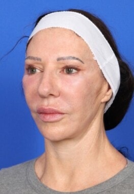 Case # 15 after photo